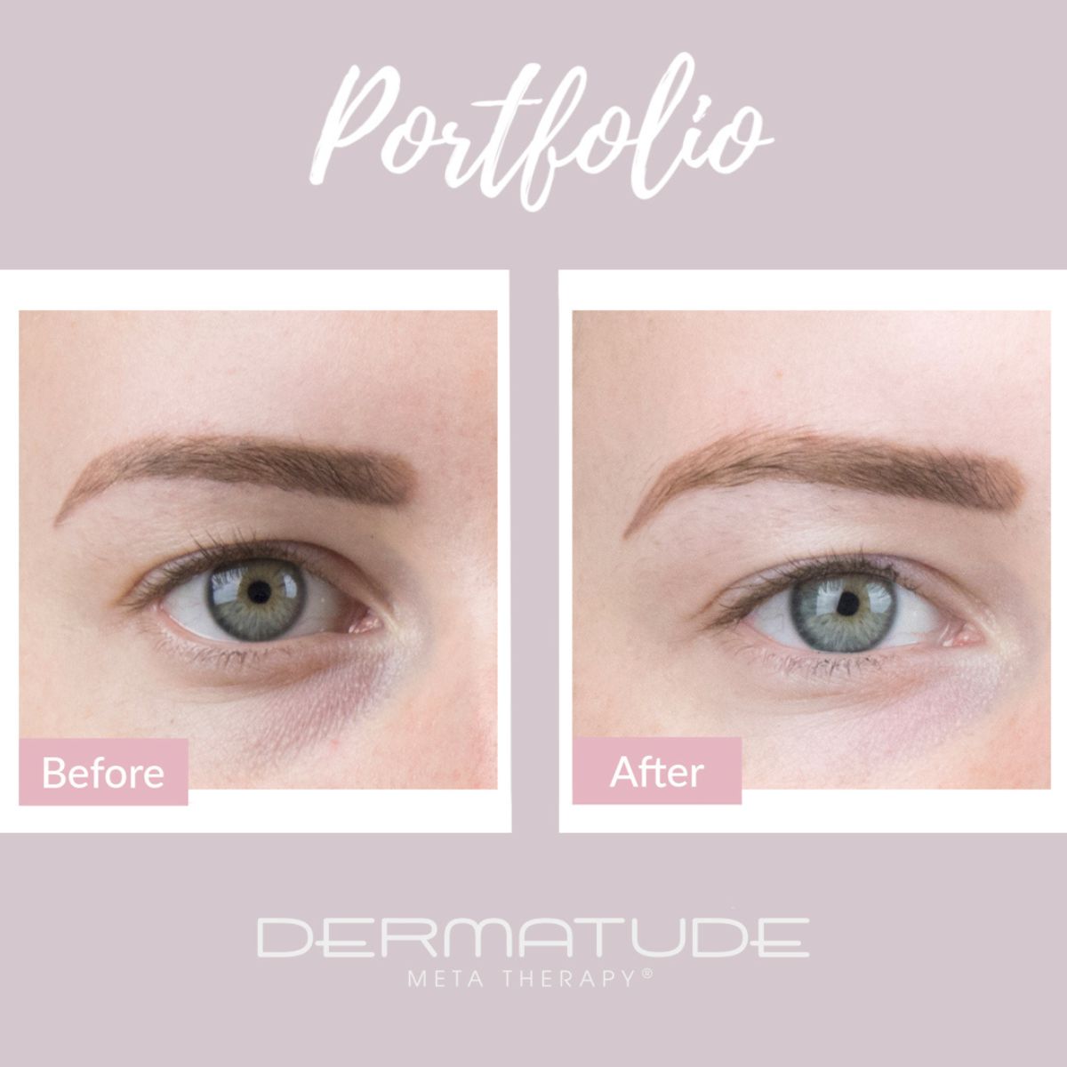 Dermatude Meta Therapy Before & After Around Delicate Eye Area